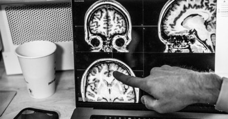 How the aging brain may impact recovery