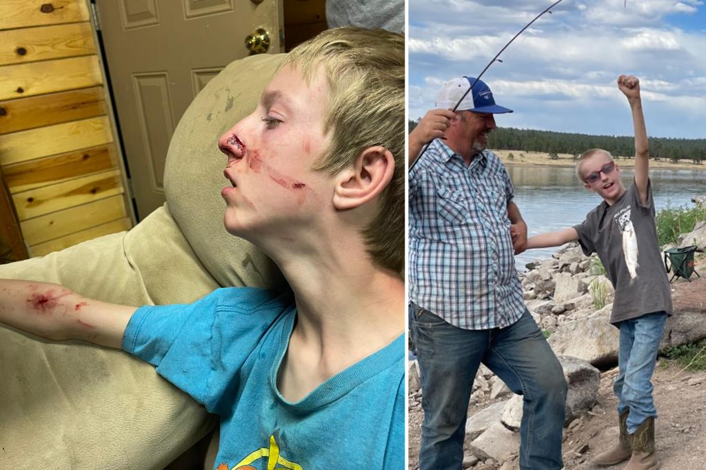 Bear mauls teen with rare disorder as he watched TV in Arizona cabin: ‘This is not normal’