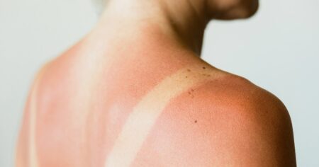 What To Look For And How To Treat