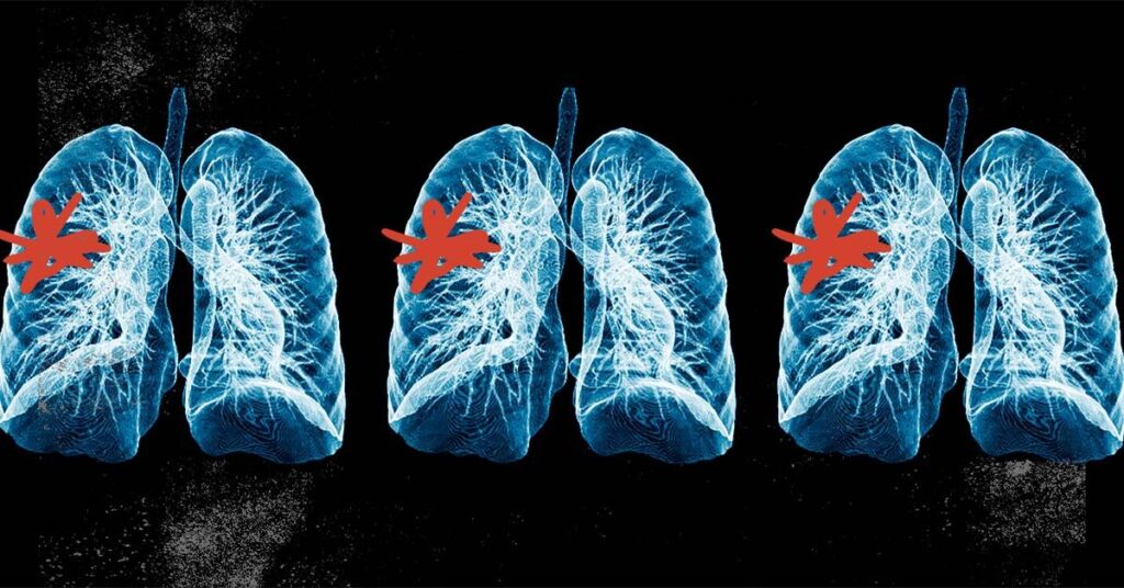 Trial shows benefits of diagnosing conditions early