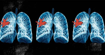 Trial shows benefits of diagnosing conditions early