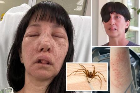Atlanta mom suffers horrific injuries after being attacked by cluster of deadly spiders: Skin felt ‘on fire’