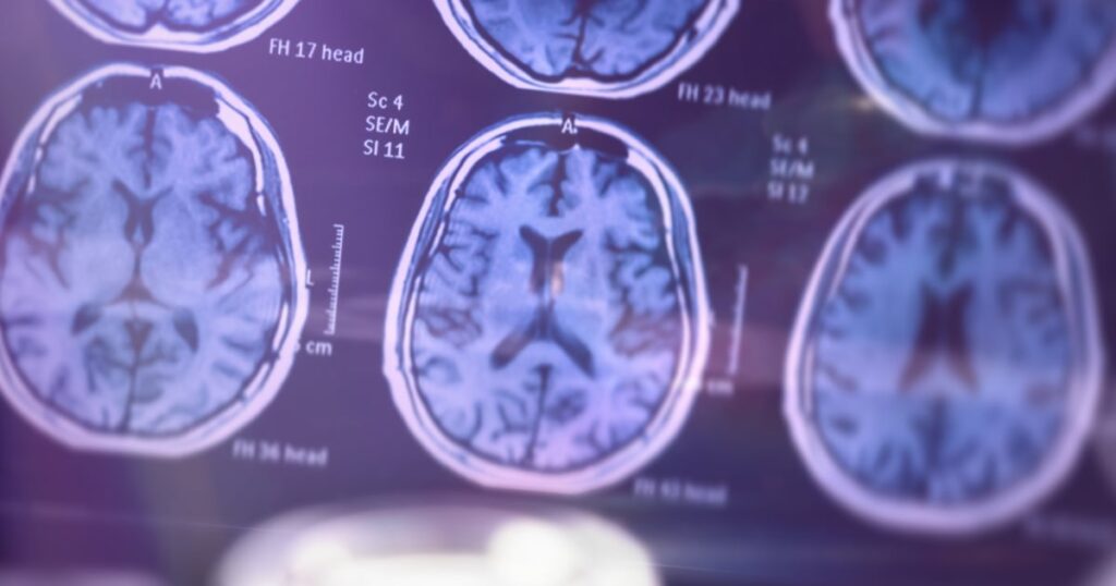 Blood Tests For Alzheimer’s May Be Available at Doctor’s Offices