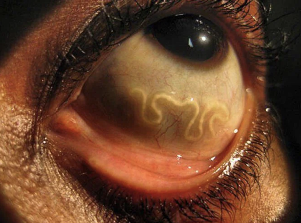 Close-up of a human eye with a parasitic worm clearly visible under the conjunctiva, indicating an eye infection