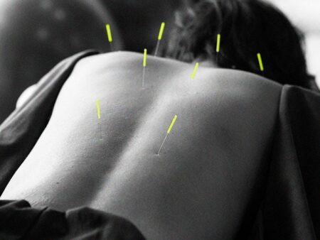 Parkinson’s disease: Can acupuncture improve sleep?