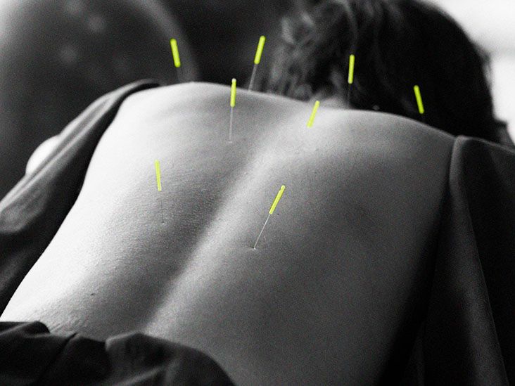 Parkinson’s disease: Can acupuncture improve sleep?