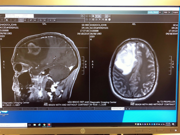 The couple saw his brain scan with the tumor for the first time on Apr. 18, 2019. "We call it the fried egg," Ali Shadock says.