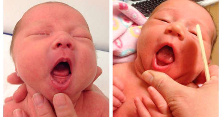 Is tongue-tie surgery for babies needed? Experts are divided