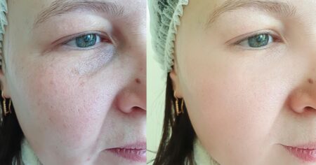 The 4 Beauty Products That Faded My Dark Spots In 1 Month