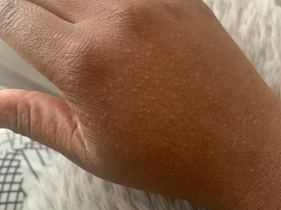 Hands after the blisters went away.