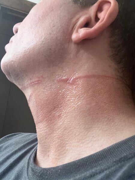 Cyclist demands change after he was struck by wire strung across Milwaukee road by Orthodox Jewish group