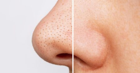 This $9 Silver Blackhead Powder Is the Trick to Unclogging Pores