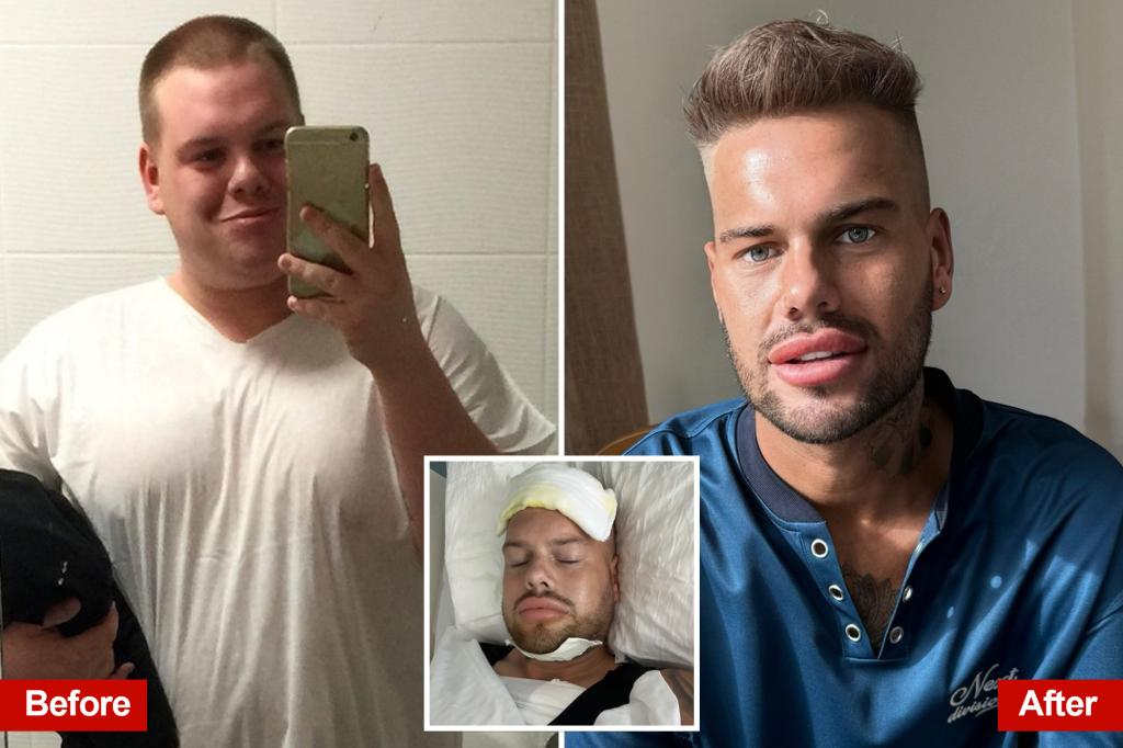 I wanted to look like an Instagram filter — so I spent over $46K on plastic surgery