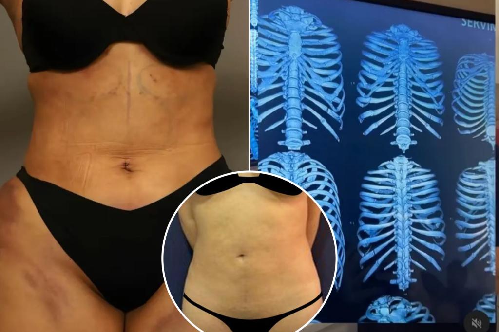 Women are spending $20K to shrink their waists in viral craze experts call ‘RibXcar’