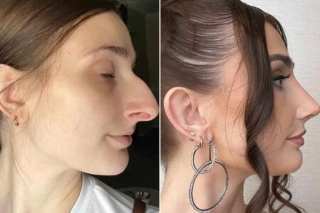 My $11K nose job helped me leave my husband