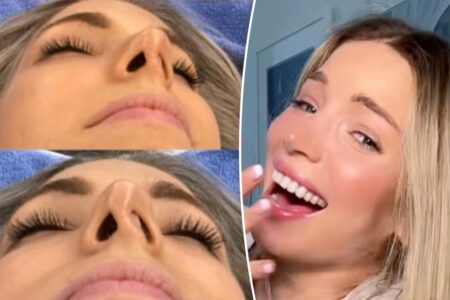 I scored a ‘free’ nose job — then got the shock of my life that came with a $26K pricetag