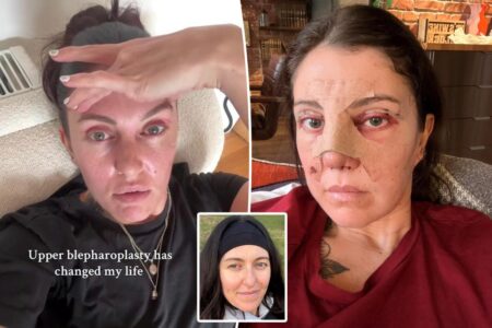 I spent $6K on a nose job, eyelid surgery before my wedding — it was worth every penny