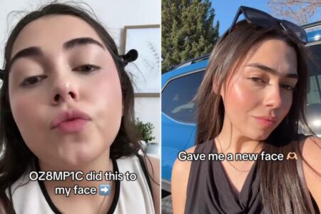 ‘Ozempic face’ might cause sagging skin — but one user loves her new look: ‘Like I got jawline filler’