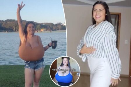 My breasts grew so big in a year I need a 10-hour, 22-pound reduction — it’s due to a super rare condition