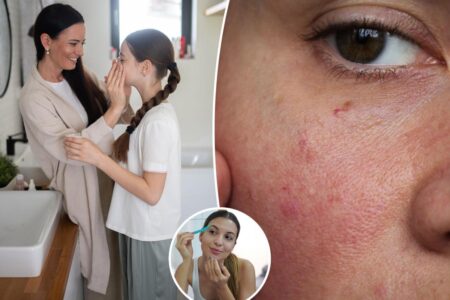 Kids and tweens are developing lifelong issues because of their skincare routines, warns derm — the No. 1 culprit