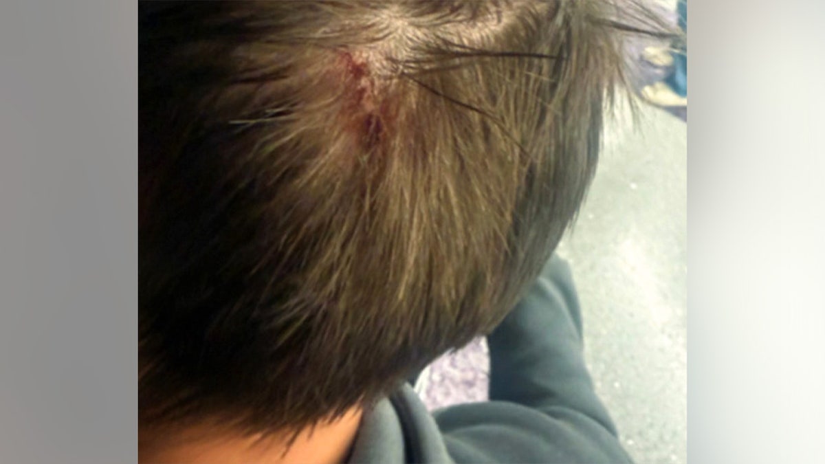 17-year-old victim's bloody scalp following the alleged attack