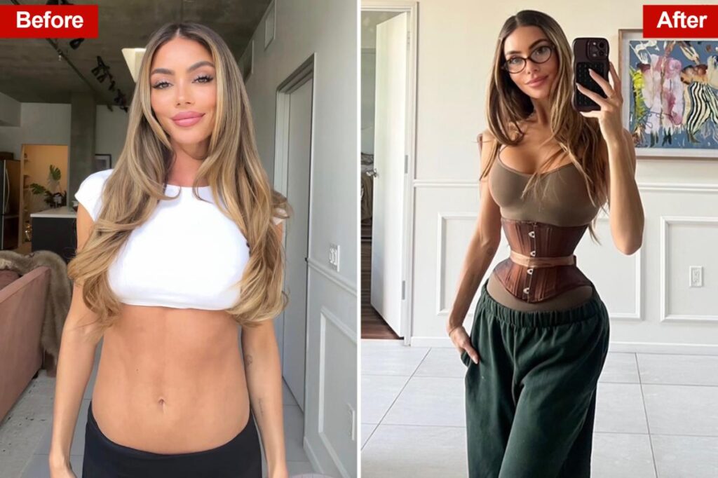 Exclusive | Young women are dropping thousands on gruesome rib removal surgery — as dangerous ‘Ozempic body’ trend takes hold