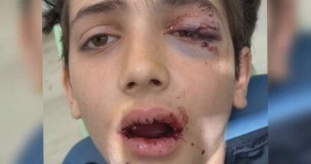B.C. boy badly injured by child riding e-scooter on school grounds