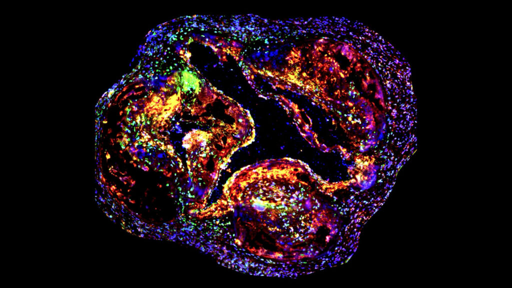 Sleep and exercise may dampen genetic drivers of heart disease