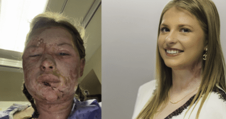 World-first burn treatment shows ‘remarkable’ results in Canadian patient