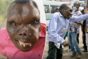 I’m the ‘world’s ugliest man’ — my rare disease turns my muscles and tissue into bone