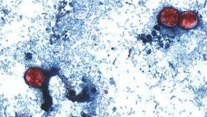 Inside the fight against the parasite Cyclospora