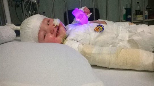 Charlie Burgess was only 11 months old when he suffered burns after pulling a deep fryer off the kitchen bench.
