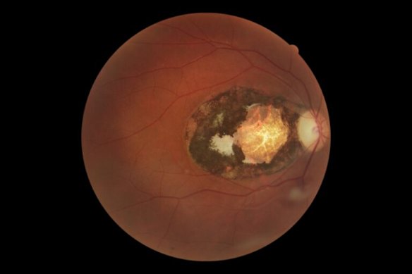 A scar on an eye caused by toxoplasmosis.