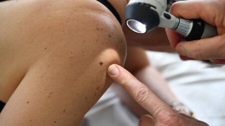 A new cancer vaccine may keep melanoma from coming back