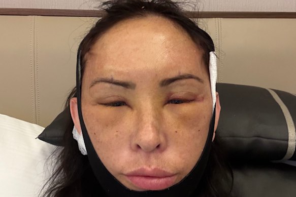 Joanne McGinniss in the days after her extensive cosmetic surgery.