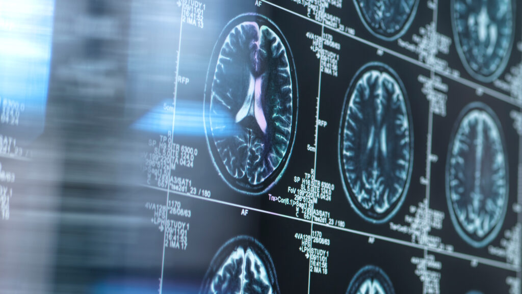 MRIs show brain changes linked to Alzheimer’s years in advance