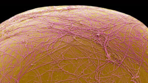 An experimental drug kills fat cells, rather than shrinking them