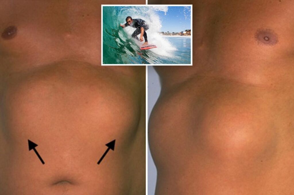 Southern California surfers are being diagnosed with a bizarre ‘tumor’ condition