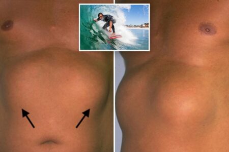 Southern California surfers are being diagnosed with a bizarre ‘tumor’ condition